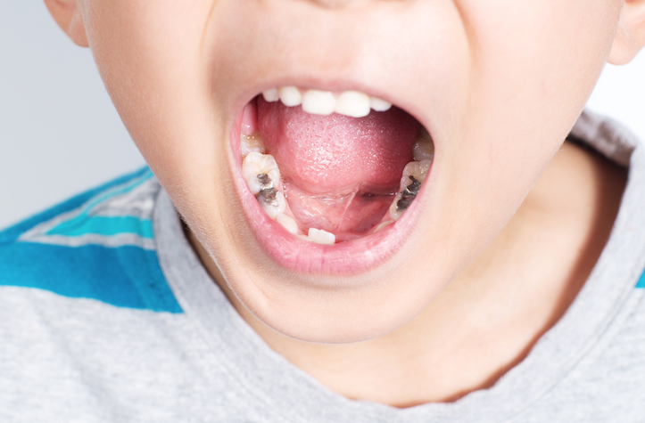 sakit gigi pada anak kecil 11